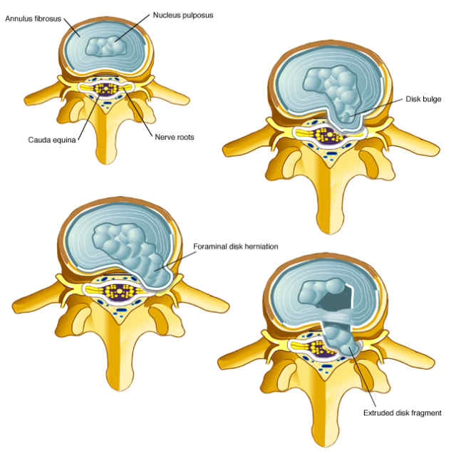 Lumbar Disk-Herniation